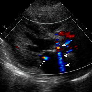 False positive of the color Doppler twinkling artifact in a... | Download Scientific Diagram