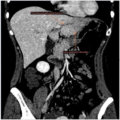 Coronal CT image. Diagnosis of pylephlebitis with impaired perfussion... | Download Scientific ...