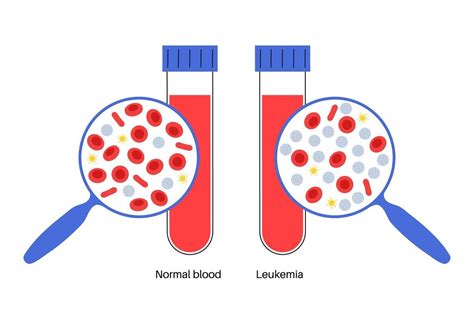 Blood Cancer Treatment Cost In India