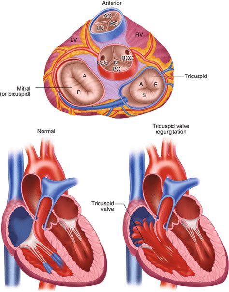 Tricuspid Valve: Tricuspid Regurgitation | Thoracic Key