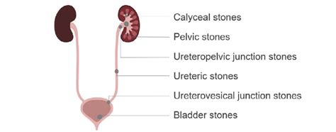 Abdominal CT: renal stones • LITFL • Radiology Library