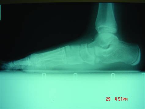 Top Ten Lower Extremity Conditions In Pediatric Patients