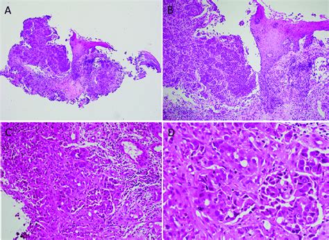 Histopathological images of the biopsy specimen. (A), (B). The biopsy ...