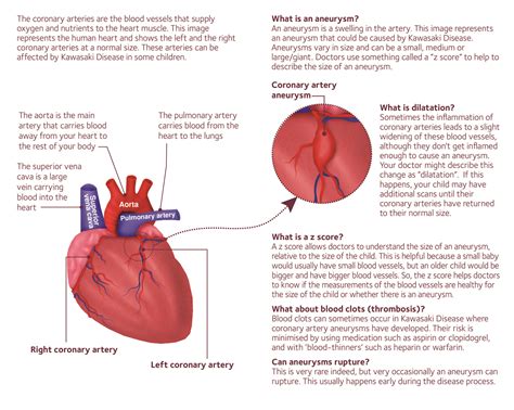 What is a coronary artery aneurysm-02 - Societi