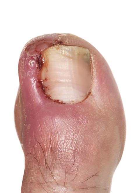 Surgery for ingrowing toenails in Epsom, Surrey by Epsom Footcare