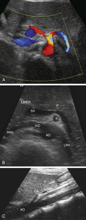 Ultrasound Assessment of the Splanchnic (Mesenteric) Arteries | Radiology Key