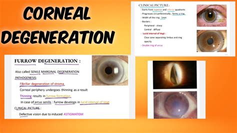 corneal degeneration |classification | symptoms | treatment | ophthalmology | English - YouTube
