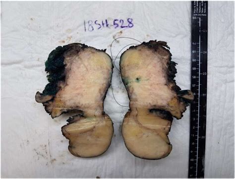 Pathology specimen: left thyroid lobectomy. | Download Scientific Diagram