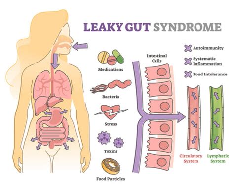 What is Leaky Gut? Leaky Gut Syndrome Symptoms! – TumTree