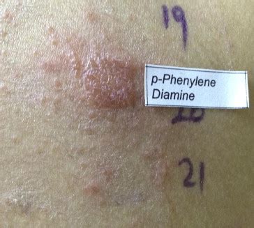 A Child with Allergic Contact Dermatitis Due to Para-Phenylenediamine - The Journal of Allergy ...