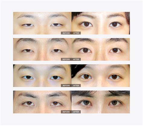 Ptosis Correction | VIP Plastic Surgery Korea