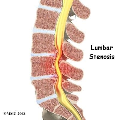 Lumbar Stenosis - Mississauga and Oakville Chiropractor and Physiotherapy Clinic - FREE Consult!