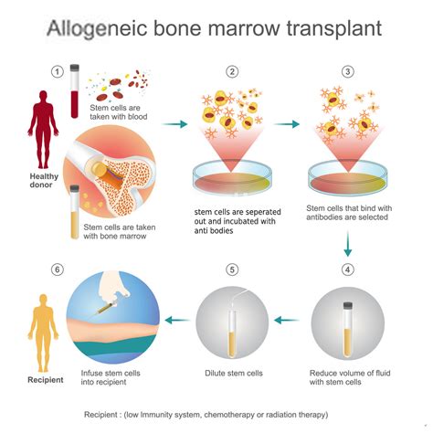 9 unknown facts to know about bone marrow transplantation