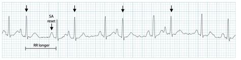 Premature Atrial Complex (PAC) - Life in the Fast Lane ECG library