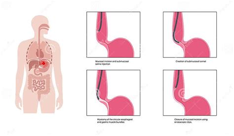 POEM medical poster stock vector. Illustration of vector - 290646818