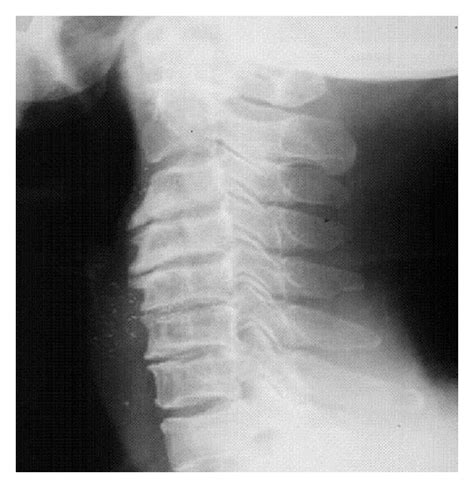 Cervical Spondylosis X Ray Findings