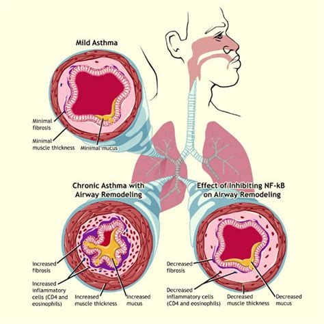 Asthma Airway Inflammation