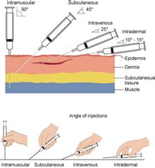 Injection (medicine) - Wikipedia