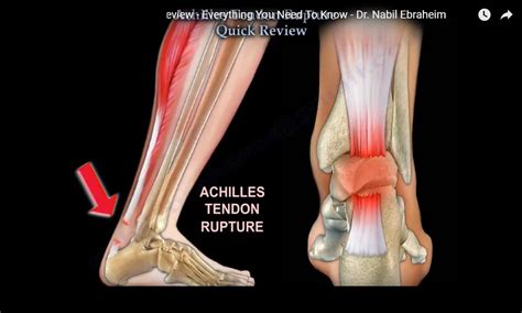 Achilles Tendon Rupture Sign