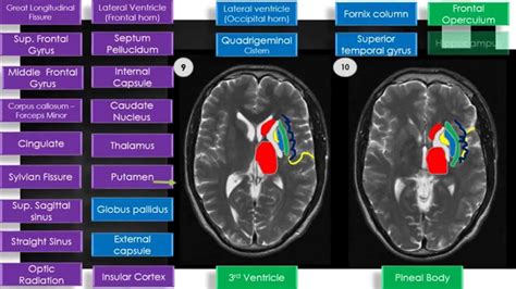 MRI Brain Sectional Anatomy Cut 9 & 10 - YouTube