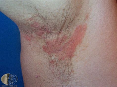 Seborrheic Dermatitis Pictures, Scalp and Face Treatment, Evidence | eHealthStar