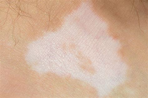 Psoriasis White Patches: What Happens to Your Skin During a Flare-Up?