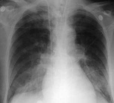 Pulmonary Edema Chest X Ray