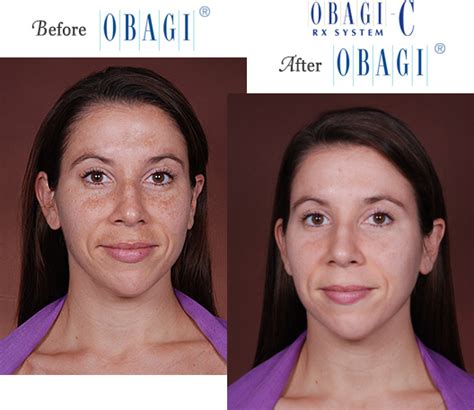 Obagi® Before and After Pictures – Micki Ly M.D. Maui Dermatologist