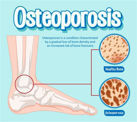 Osteogenesis Imperfecta – Types, Symptoms, & Treatment Options