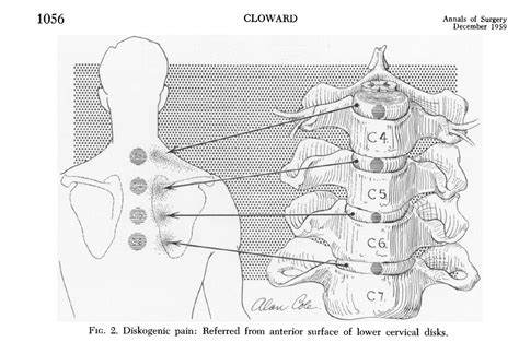 Diagram Of Shoulder Blade ~ Reverse Total Shoulder Replacement | Johns ...