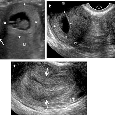 A Year Old Woman With Cervical Ep Longitudinal Ultrasound Image Of ...