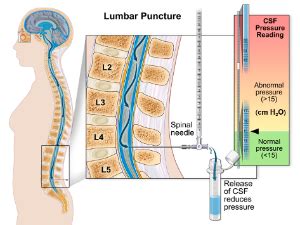 spinal tap | Lumbar puncture, Spinal tap procedure, Neurology