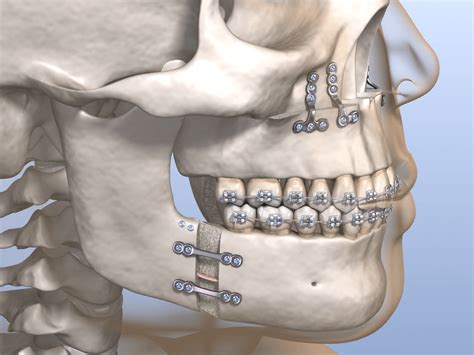 Qué es la cirugia ortognática - SCULP!