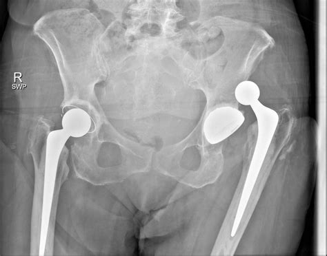 An unusual complication of hip dislocation after total hip replacement | Eurorad