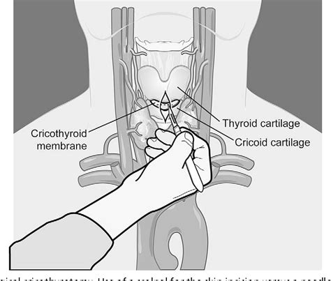 Needle cricothyrotomy. | Semantic Scholar