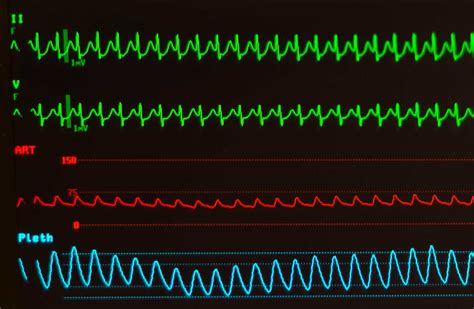 Supraventricular Tachycardia (SVT) Ablation – Australian Cardiovascular Specialists