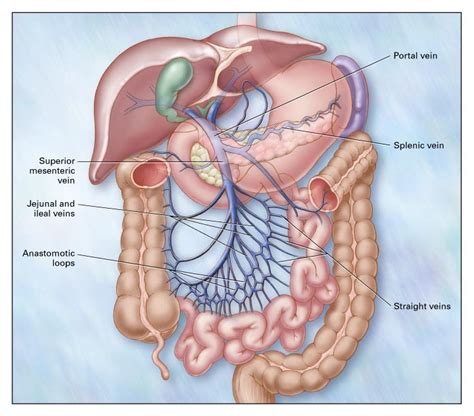 Mesenteric Venous Thrombosis | NEJM