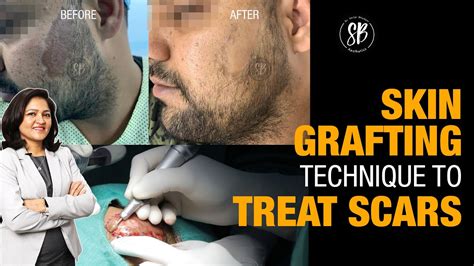 Skin Grafting Surgery | Procedure Video - YouTube