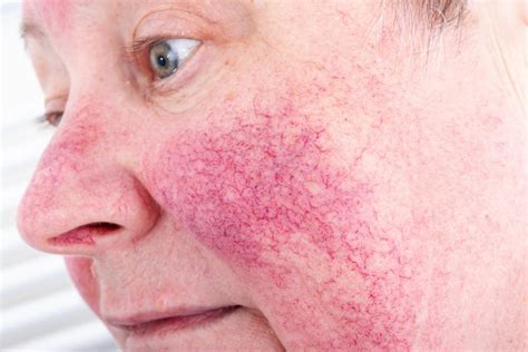 Rosacea Rash On Face