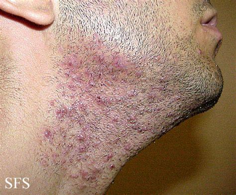 Pseudofolliculitis barbae - wikidoc