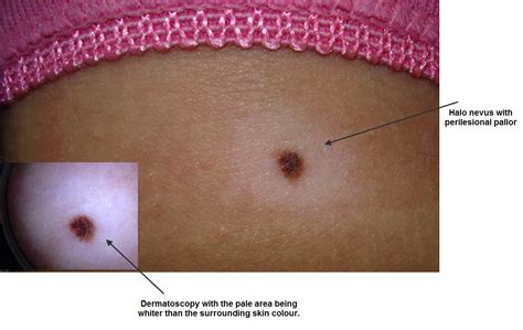 Dermoscopy Made Simple: Benign Nevus