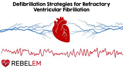 REBEL Cast Ep113: Defibrillation Strategies for Refractory Ventricular ...