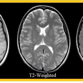 Example of 3 MRI sequences: T1-Weighted, T2-Weighted, and FLAIR. | Download Scientific Diagram