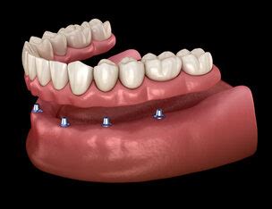 BPS Implant Dentures | Pacific Denture Clinic