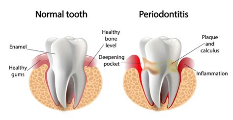 Periodontitis Stages, Symptoms, and Treatments - Austin Laser Dentist