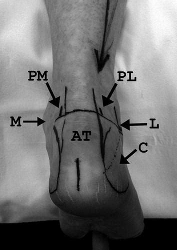 Posterior Ankle Arthroscopy and Endoscopy | Musculoskeletal Key