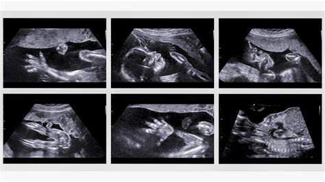 20 Weeks Ultrasound Girl