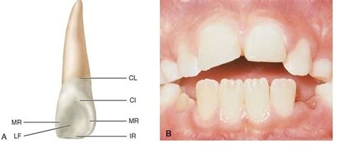 A, Maxillary right lateral incisor (lingual aspect). CL, Cervical line ...