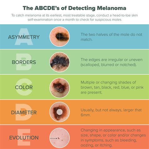 Melanoma Symptoms ABCDE: Detecting Skin Cancer Early - Doctor Heck