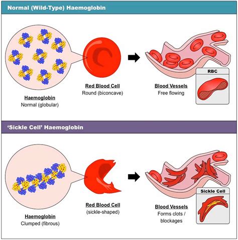 Difference Between Sickle Cell Anemia And Thalassemia